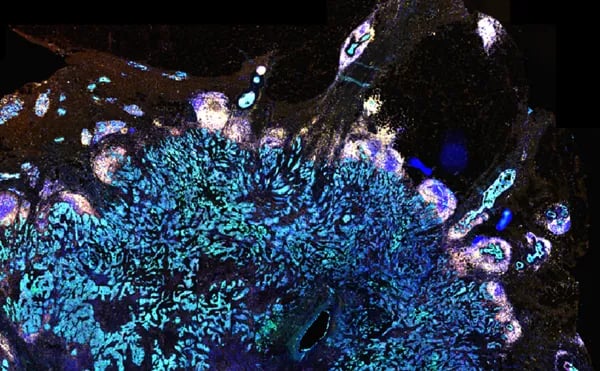 high-dimensional-multiplex-immunofluorescence-breast-cancer-image