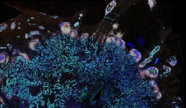Spatial biology tools for the advancement of cancer | Tribun Health